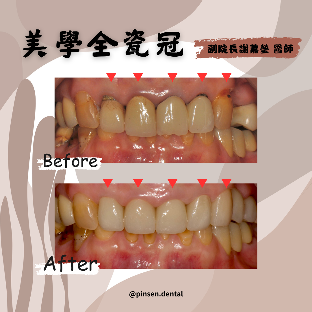 全瓷冠案例 全瓷冠案例