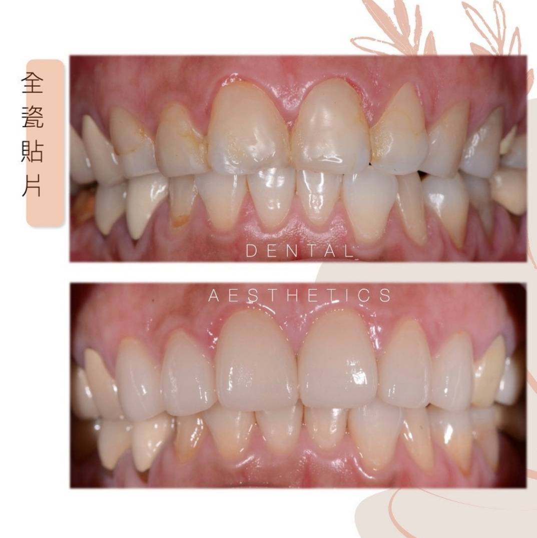 全瓷冠案例 全瓷冠案例