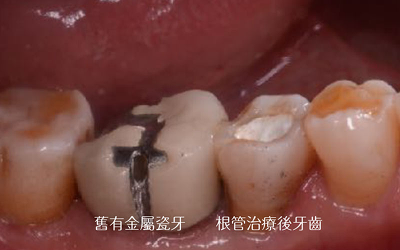 全瓷冠案例 全瓷冠案例