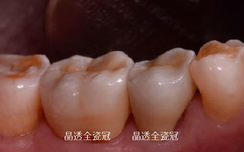 全瓷冠案例 全瓷冠案例