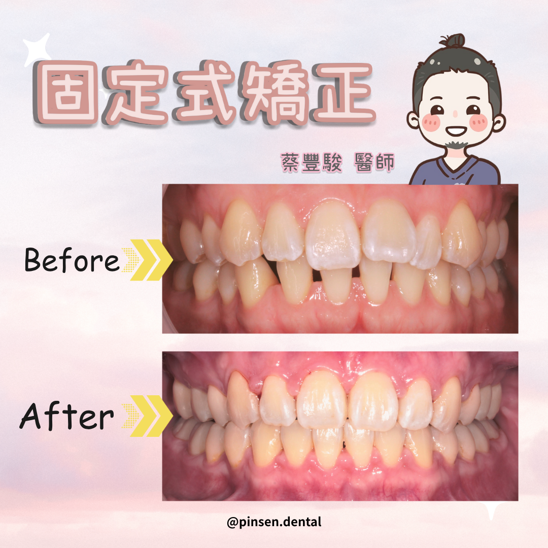 矯正案例 矯正案例