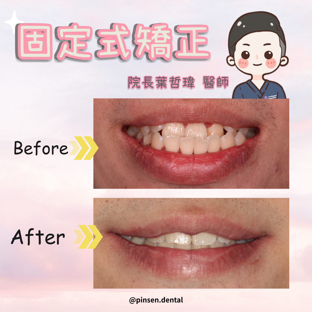 矯正案例 矯正案例
