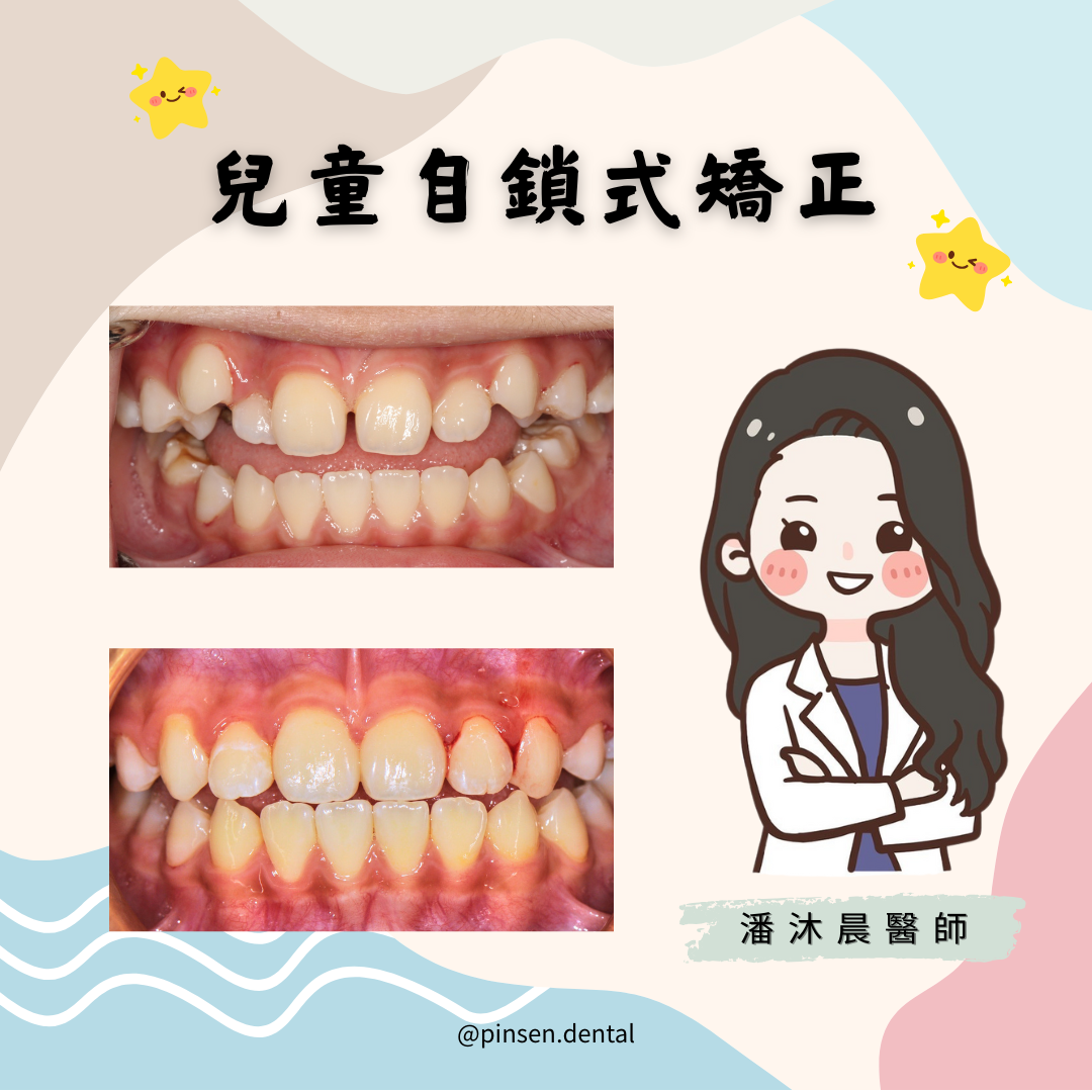 矯正案例 矯正案例