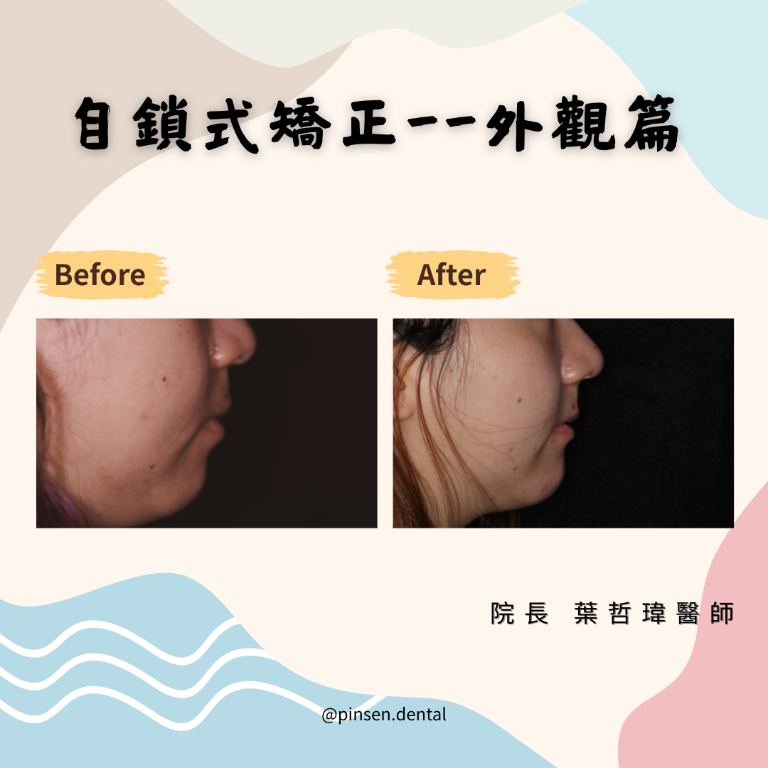 矯正案例 矯正案例
