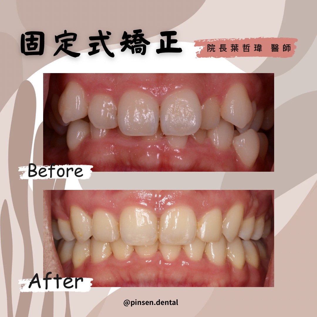 矯正案例 矯正案例