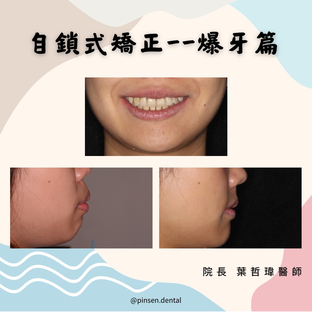 矯正案例 矯正案例