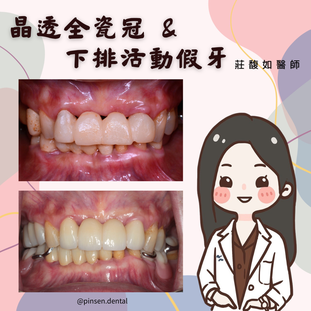活動假牙案例 活動假牙案例