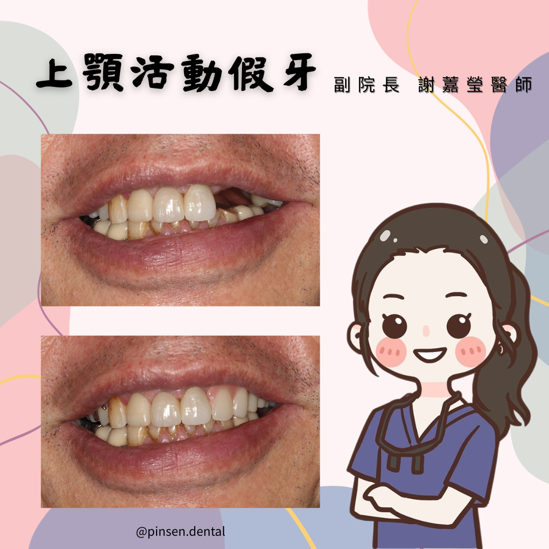 活動假牙案例 活動假牙案例