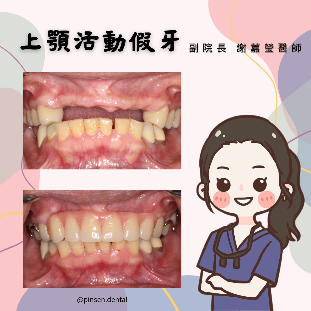 活動假牙案例 活動假牙案例