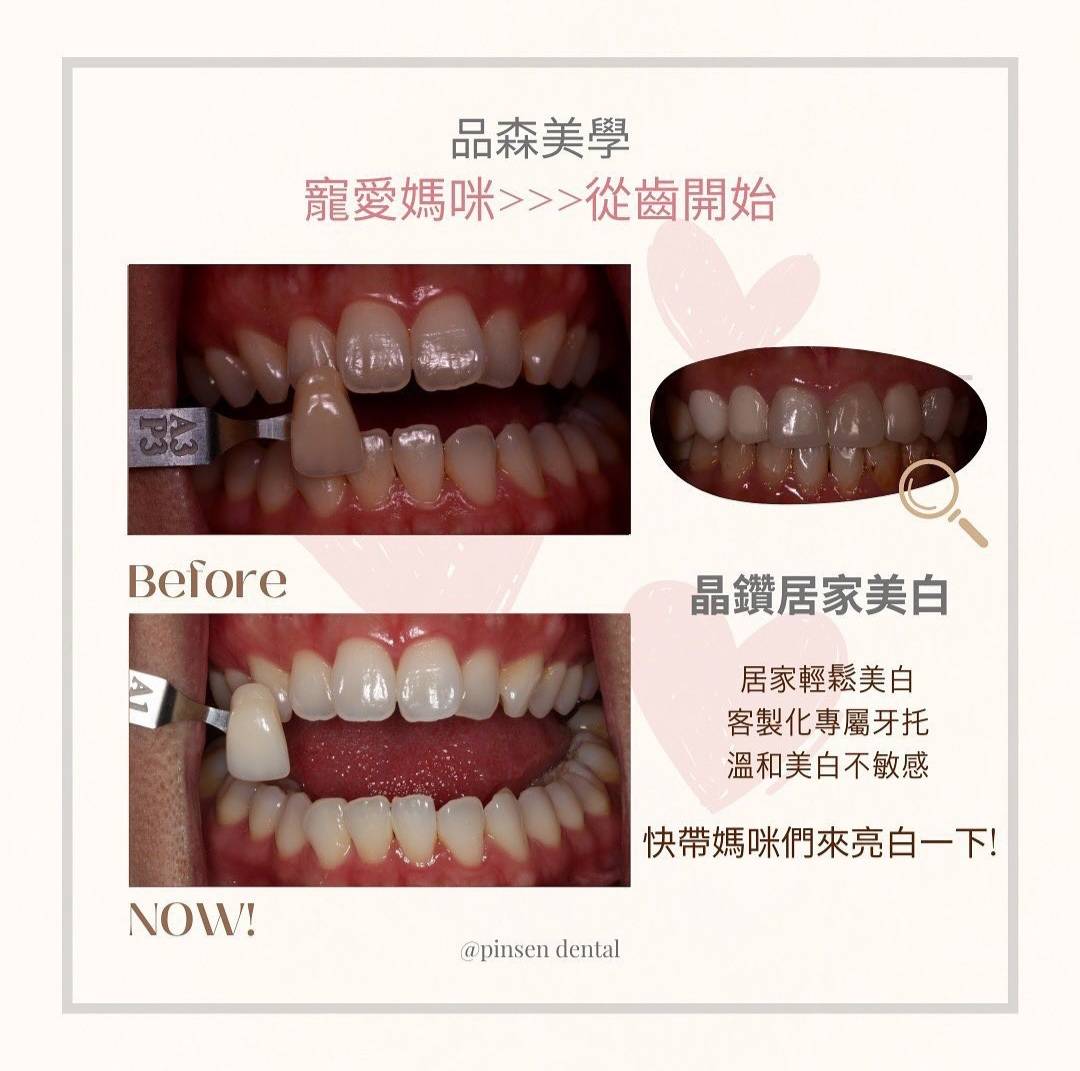 牙齒美白案例